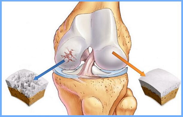 Normal knee joint and affected by osteoarthritis
