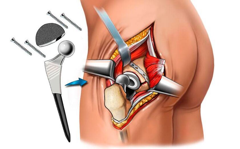 Implantation of endoprosthesis - a surgical solution to the problem of coxarthrosis