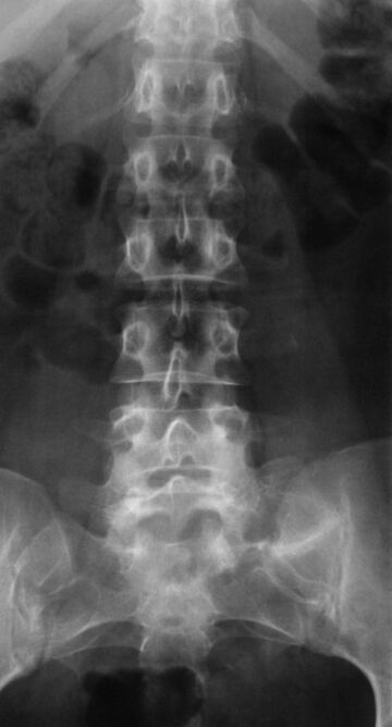 In order to diagnose lumbar osteochondrosis, a radiograph is taken