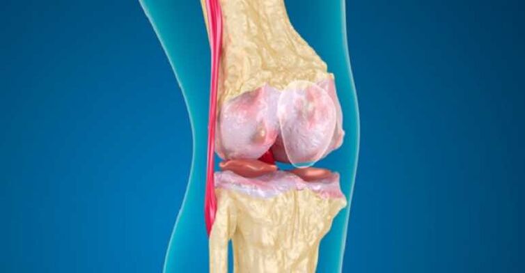 Arthrosis of knee joint diseases, causing the destruction of cartilage in the joints