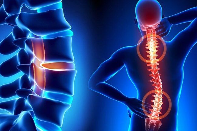 Osteochondrosis of the spinal column