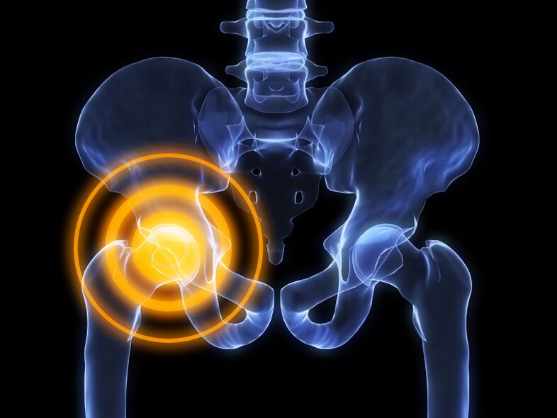 arthrosis of the hip joint