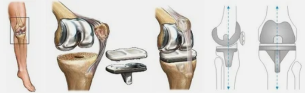 Endoprosthesis for example, the knees