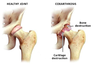 comparison of a healthy joint and the hip sustave